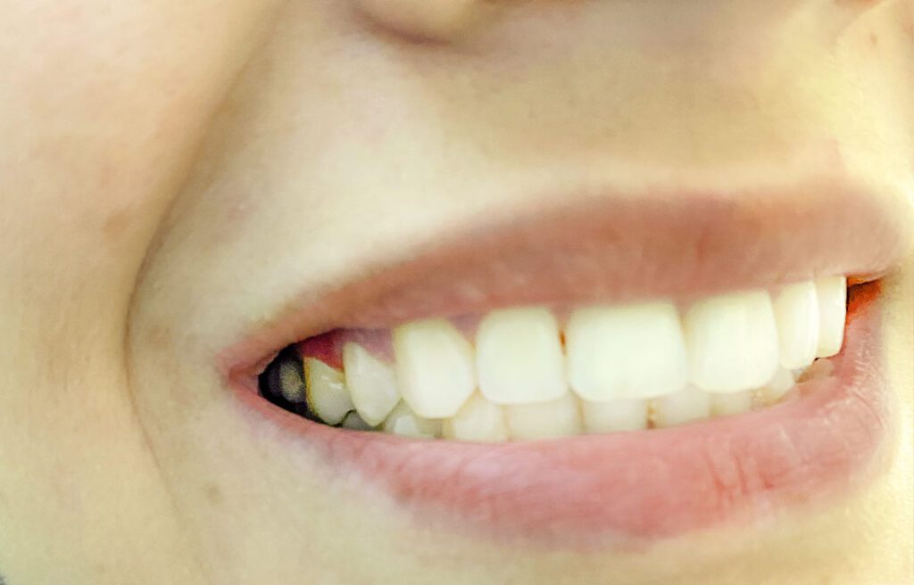 corona dental sobre implante